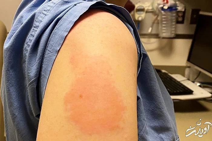 ورم ناشی از کرونا